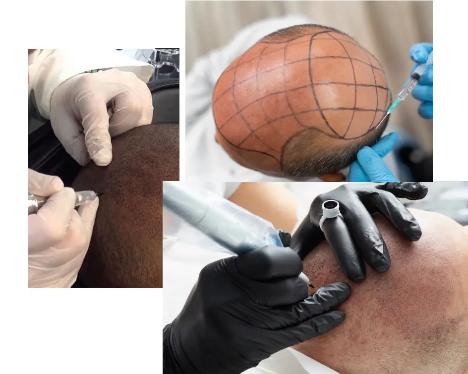 About Hair Smp Process